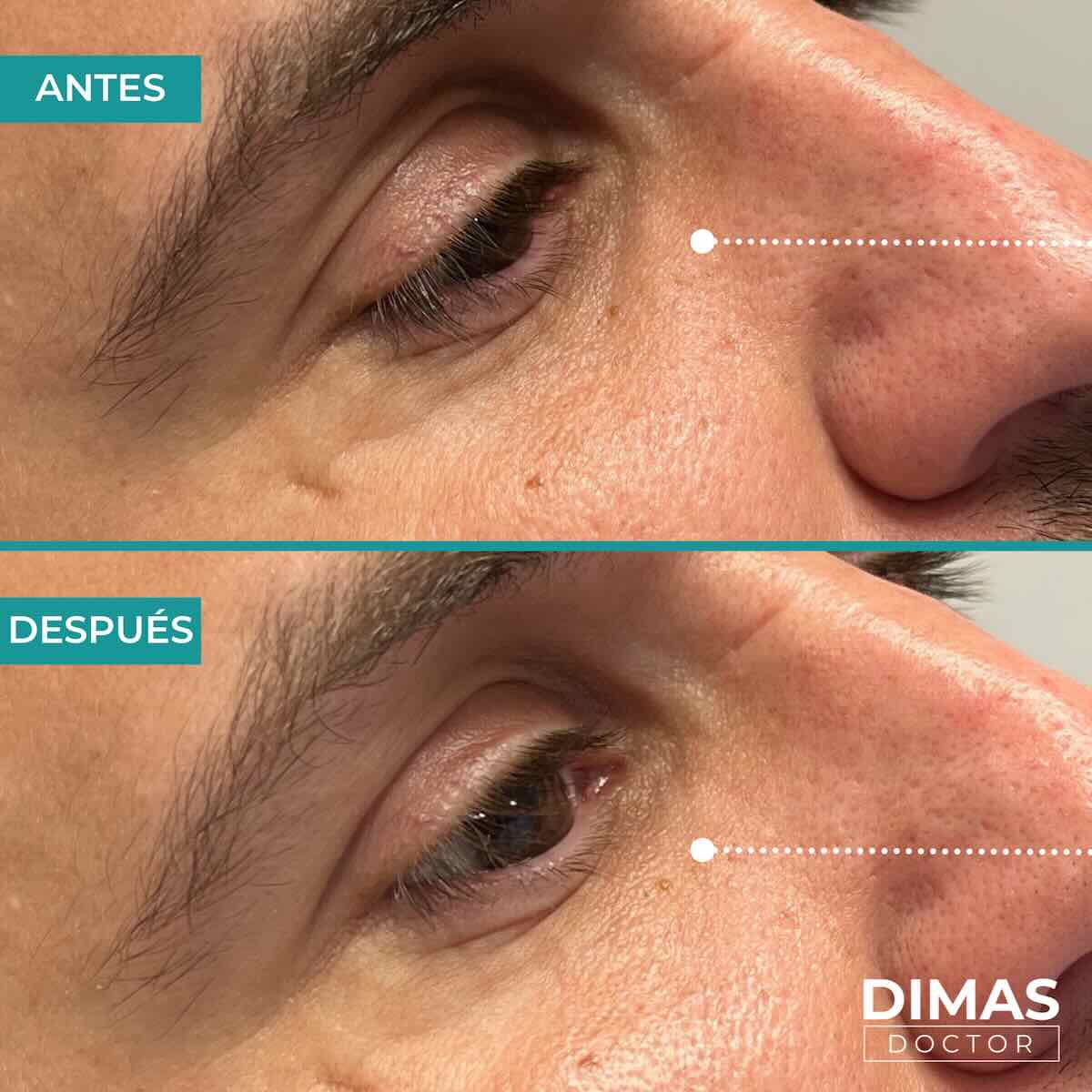 Antes y después en hombre tras el tratamiento de relleno de ojeras con ácido hialurónico en barcelona