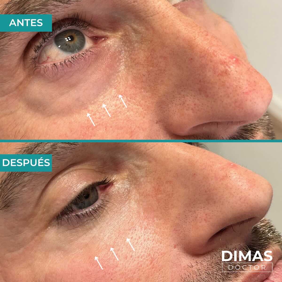 Antes y después en hombre tras el tratamiento de relleno de ojeras con ácido hialurónico en barcelona