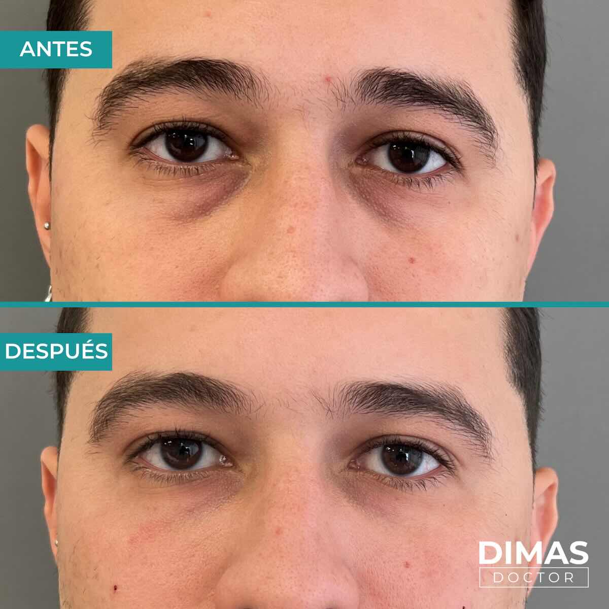 Antes y después en hombre tras el tratamiento de relleno de ojeras con ácido hialurónico en barcelona