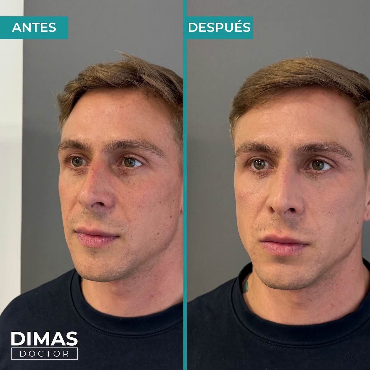 Antes y después en hombre tras el tratamiento de relleno de ojeras con ácido hialurónico en barcelona