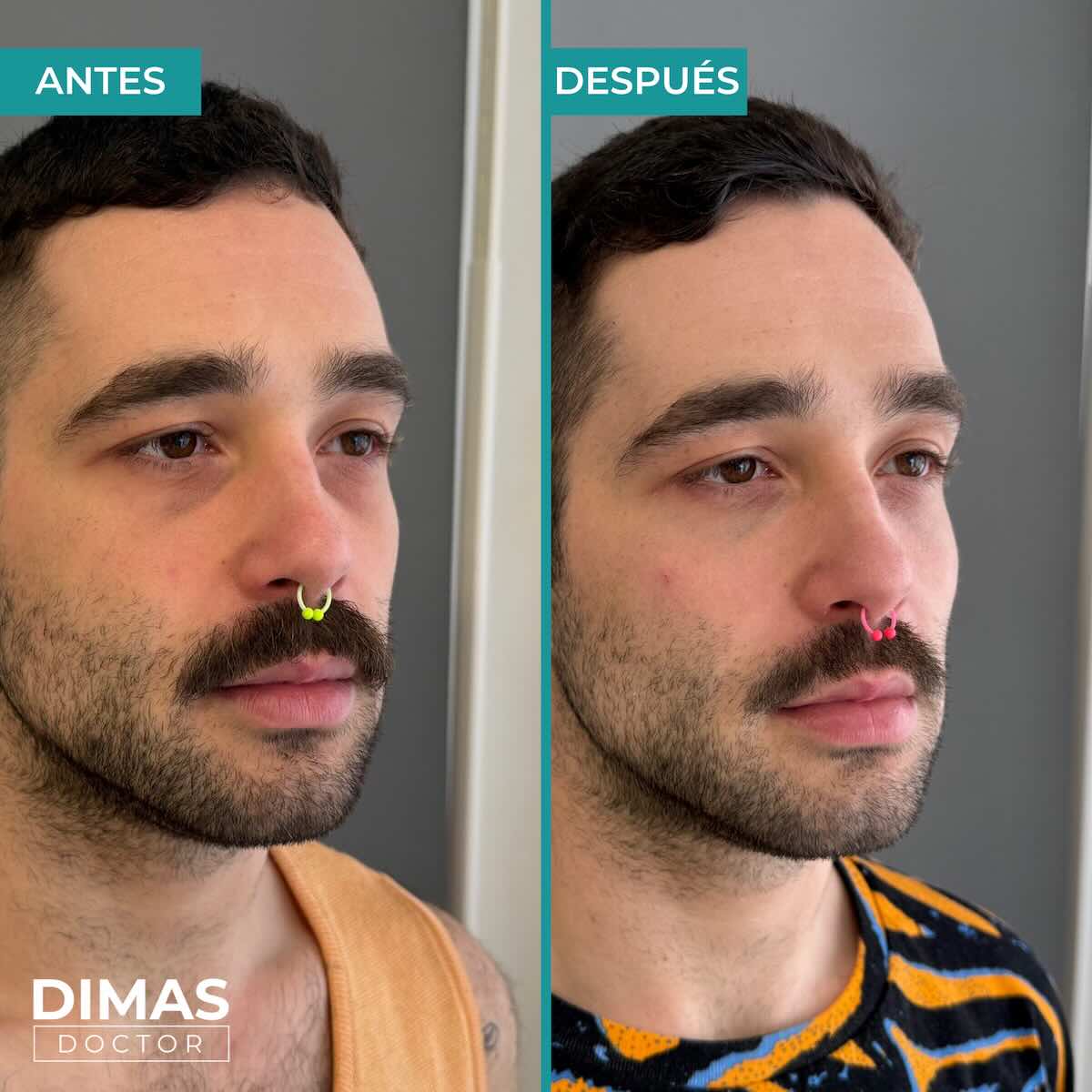 Antes y después en hombre tras el tratamiento de relleno de ojeras con ácido hialurónico en barcelona