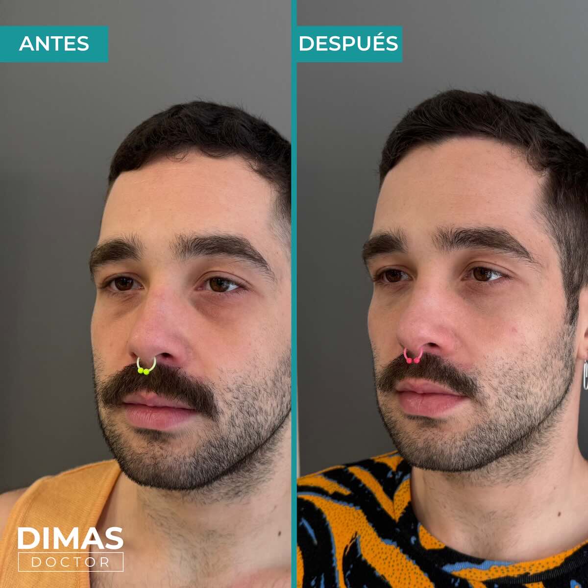 Antes y después en hombre tras el tratamiento de relleno de ojeras con ácido hialurónico en barcelona