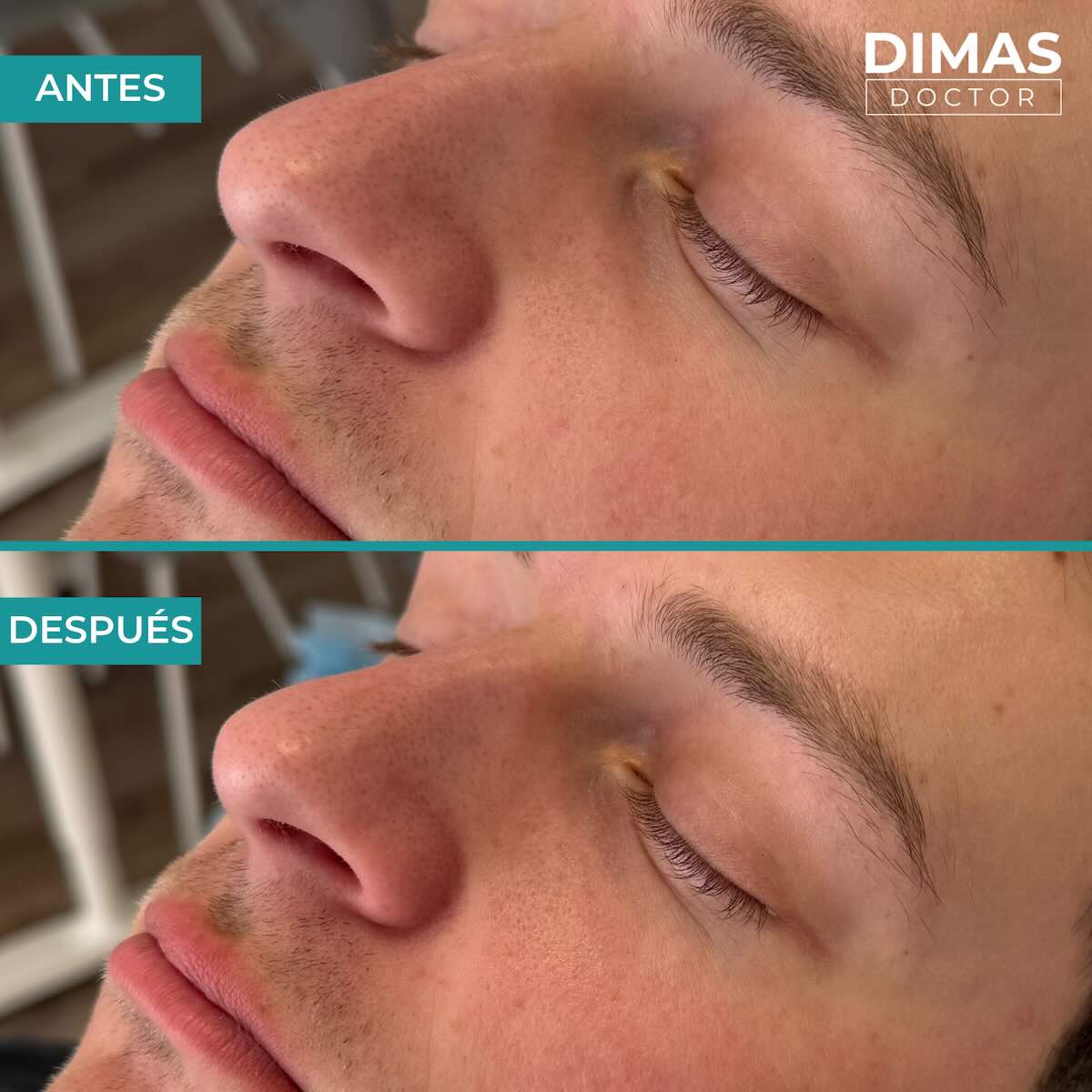 Antes y después en hombre tras el tratamiento de relleno de ojeras con ácido hialurónico en barcelona