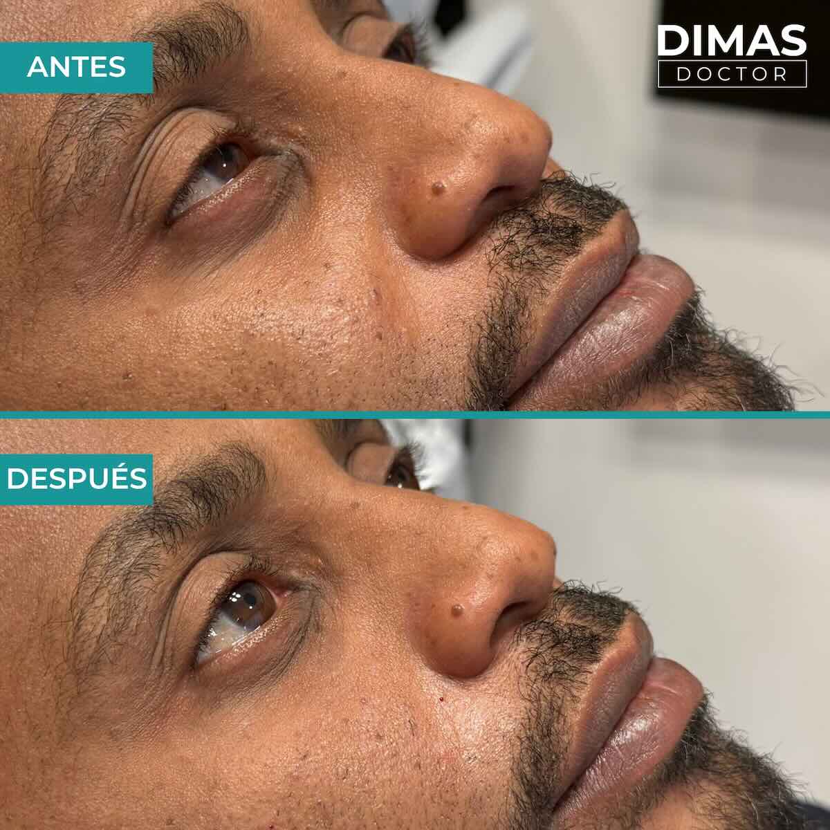 Antes y después en hombre tras el tratamiento de relleno de ojeras con ácido hialurónico en barcelona