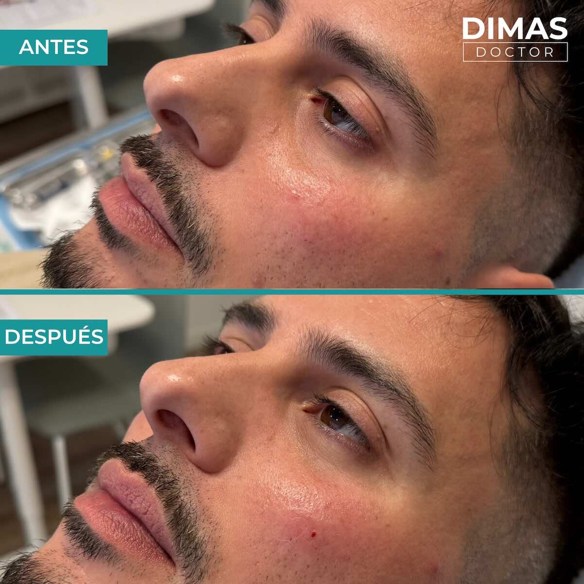 Antes y después en hombre tras el tratamiento de relleno de ojeras con ácido hialurónico en barcelona