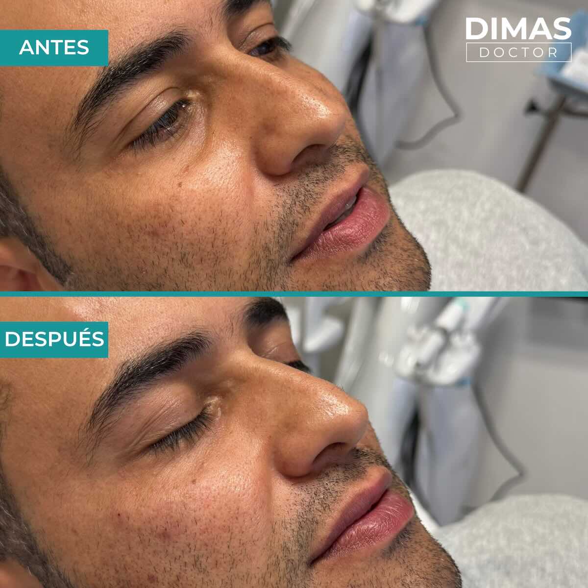 Antes y después en hombre tras el tratamiento de relleno de ojeras con ácido hialurónico en barcelona