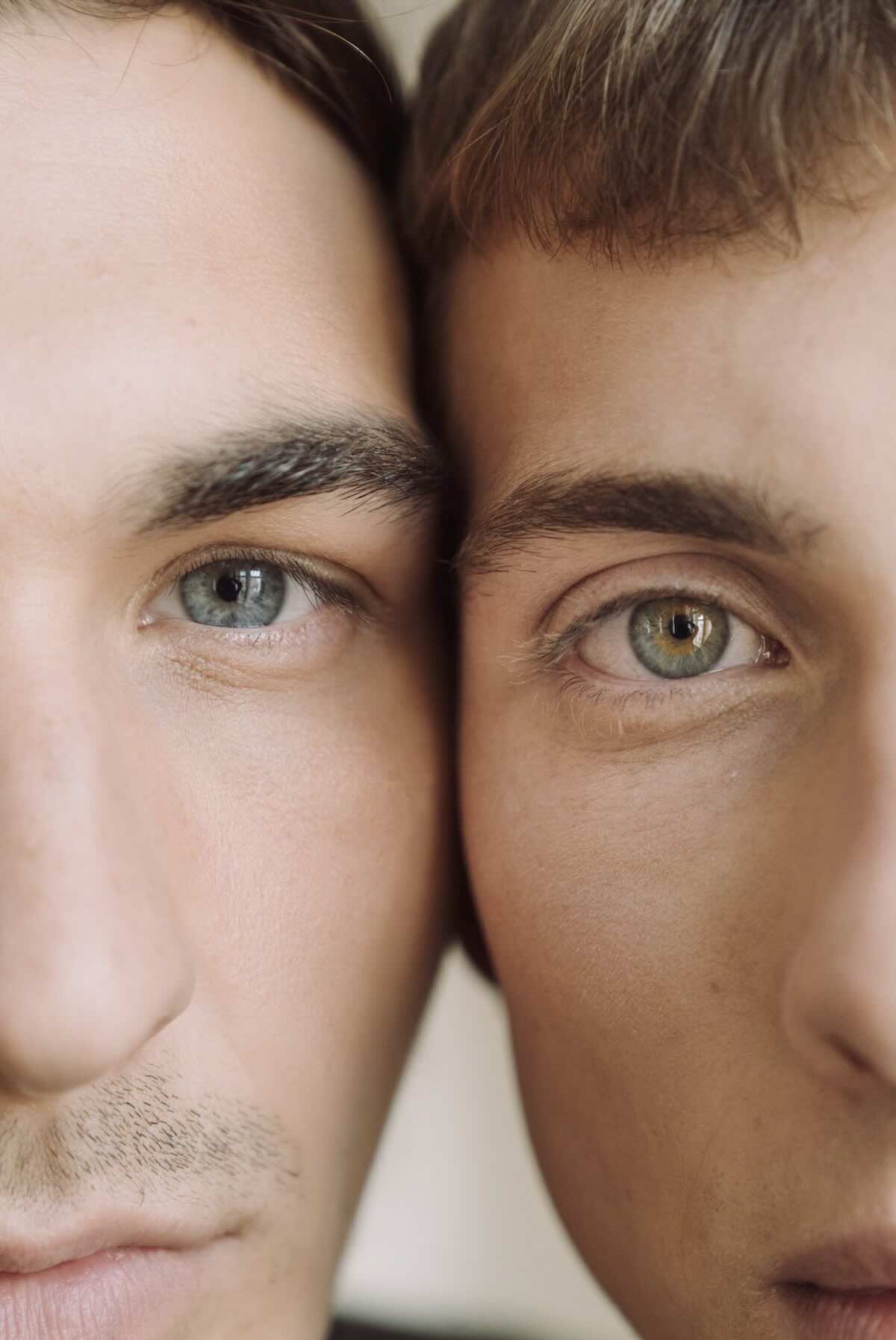 Relleno ojeras y resultado en hombres con ácido hialurónico