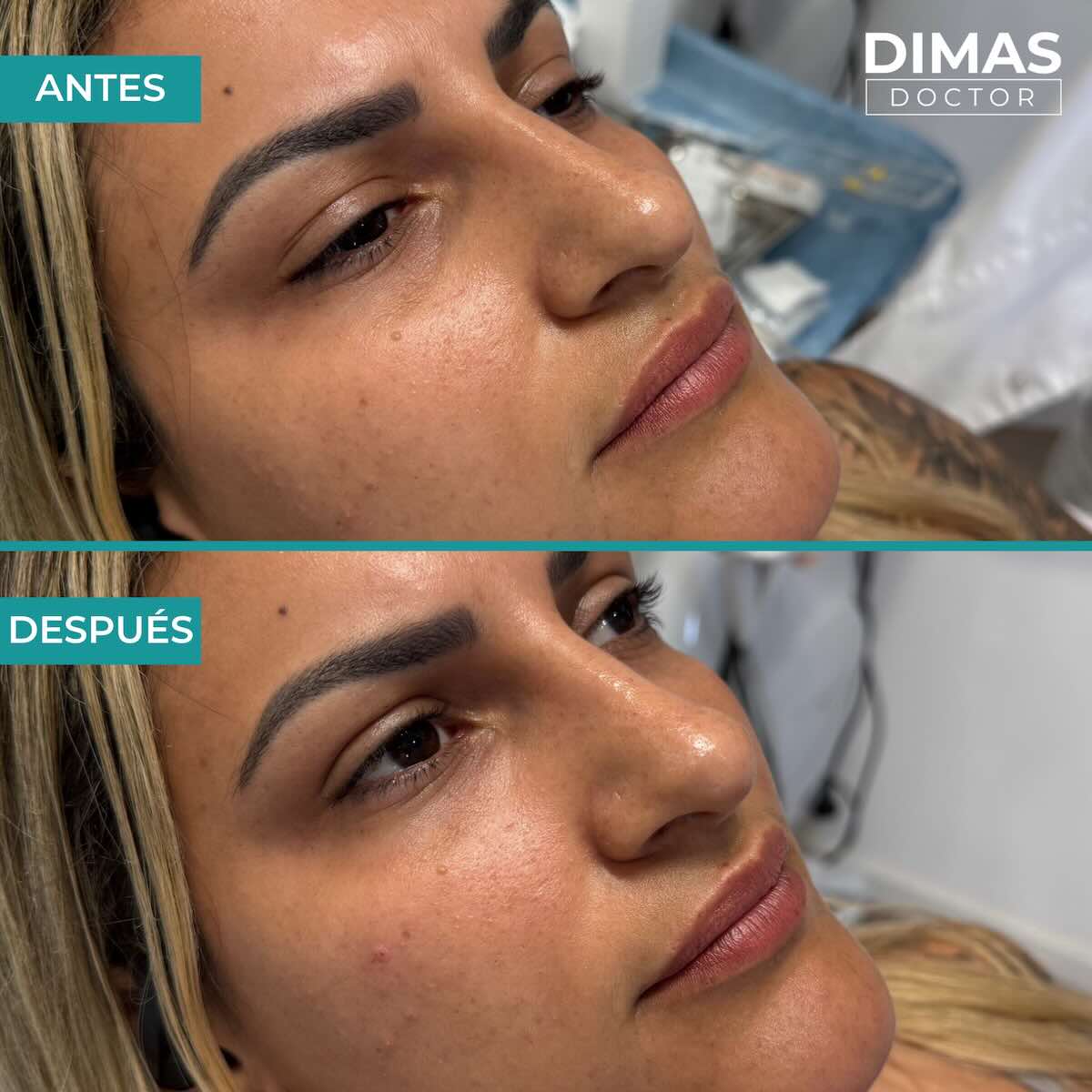 Antes y después en mujer tras el tratamiento de relleno de ojeras con ácido hialurónico en barcelona