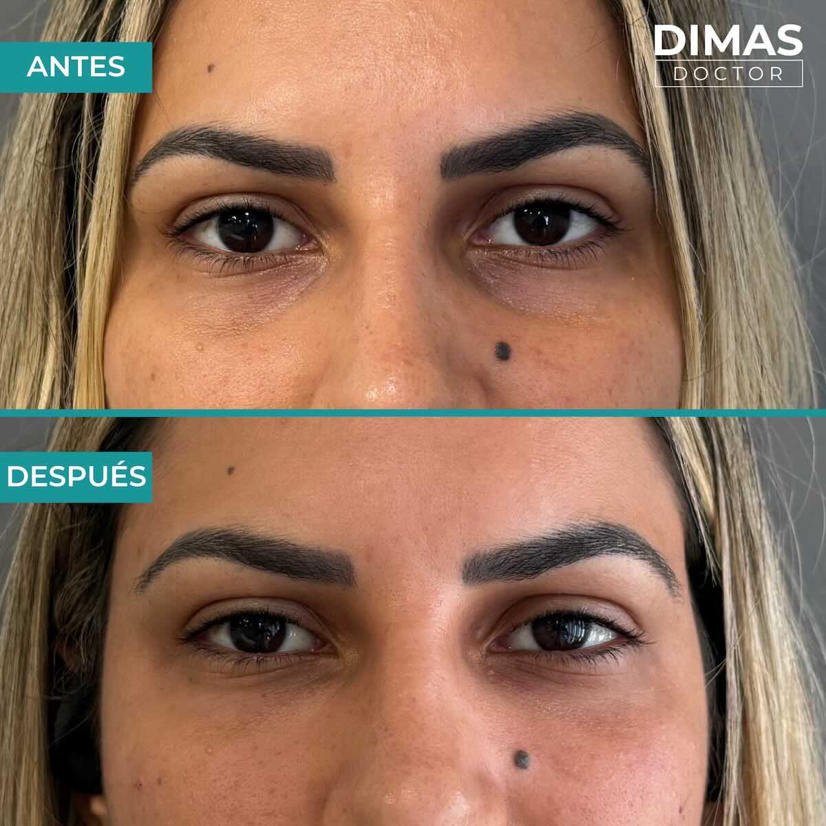 Antes y después en mujer tras el tratamiento de relleno de ojeras con ácido hialurónico en barcelona
