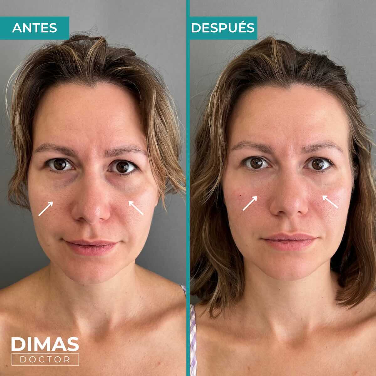 Antes y después en mujer tras el tratamiento de relleno de ojeras con ácido hialurónico en barcelona