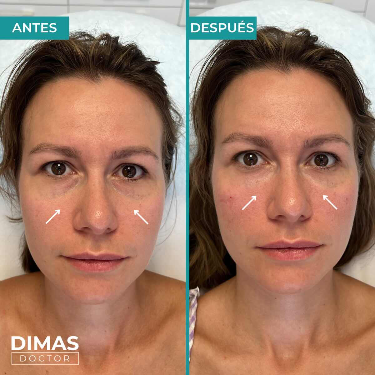 Antes y después en mujer tras el tratamiento de relleno de ojeras con ácido hialurónico en barcelona