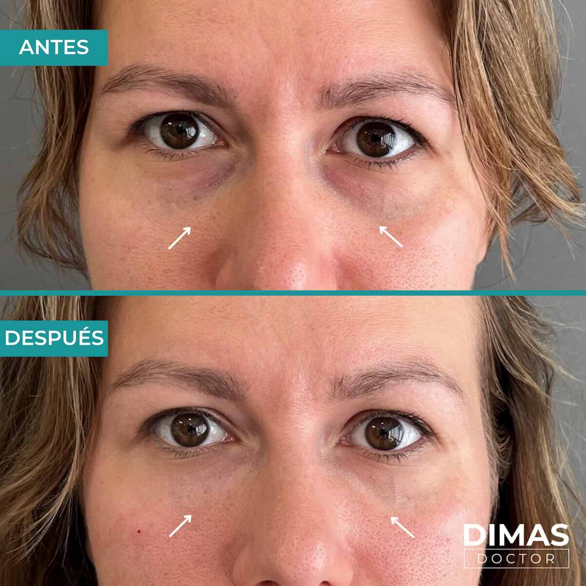 Antes y después en mujer tras el tratamiento de relleno de ojeras con ácido hialurónico en barcelona