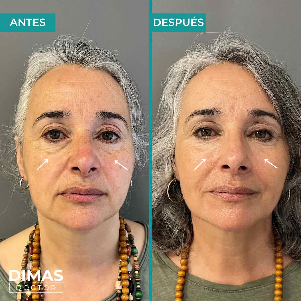Antes y después en mujer tras el tratamiento de relleno de ojeras con ácido hialurónico en barcelona
