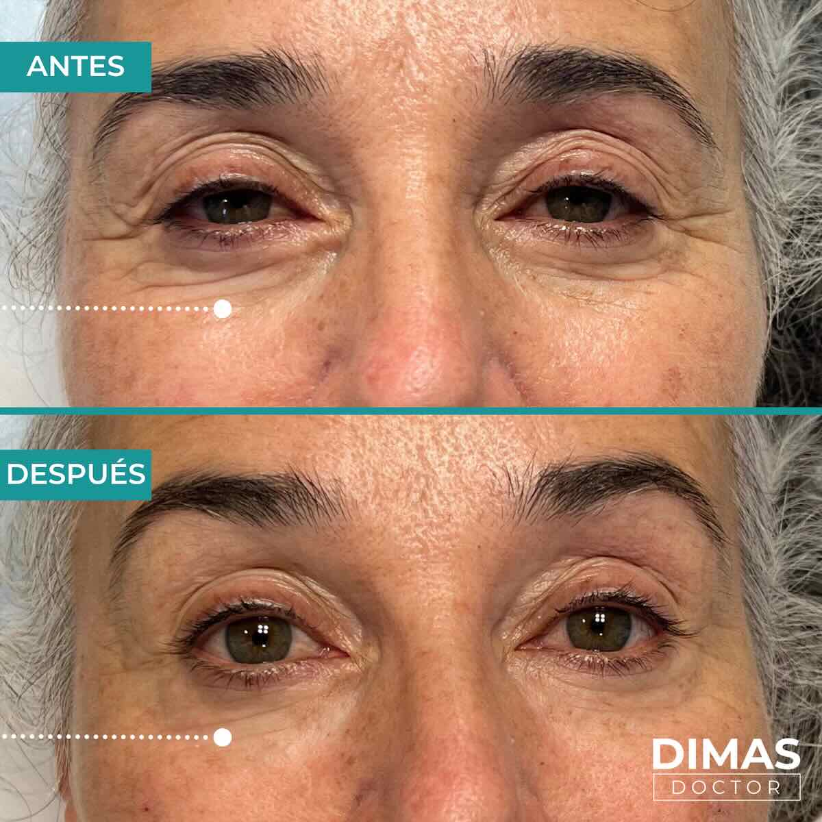 Antes y después en mujer tras el tratamiento de relleno de ojeras con ácido hialurónico en barcelona