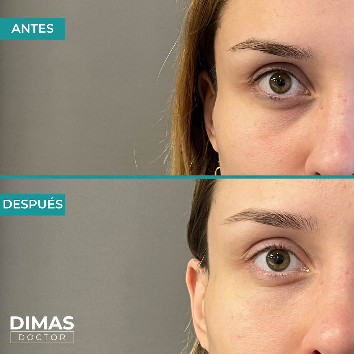 Antes y después en mujer tras el tratamiento de relleno de ojeras con ácido hialurónico en barcelona