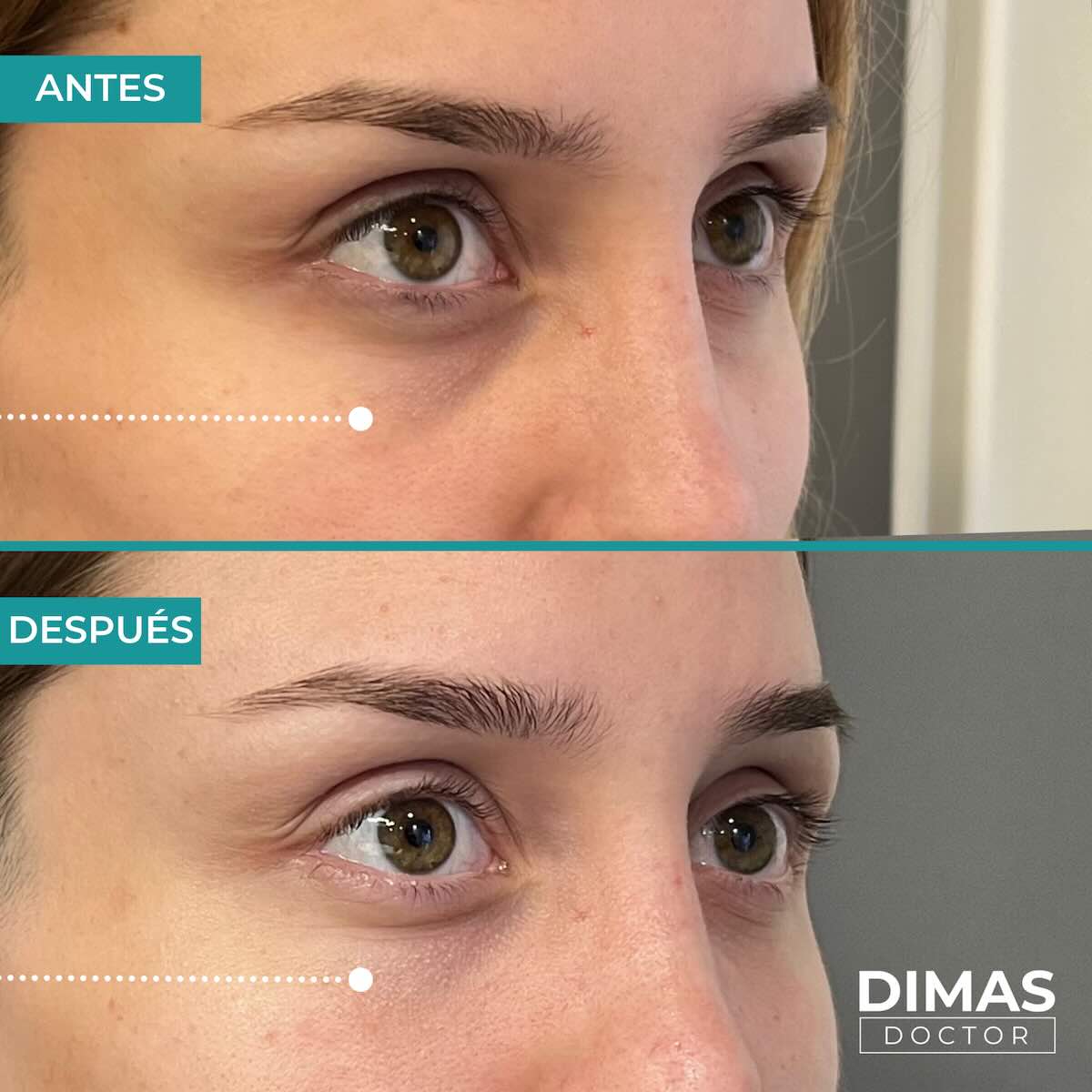 Antes y después en mujer tras el tratamiento de relleno de ojeras con ácido hialurónico en barcelona