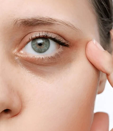 Ojera en mujer rubia con ojos azules