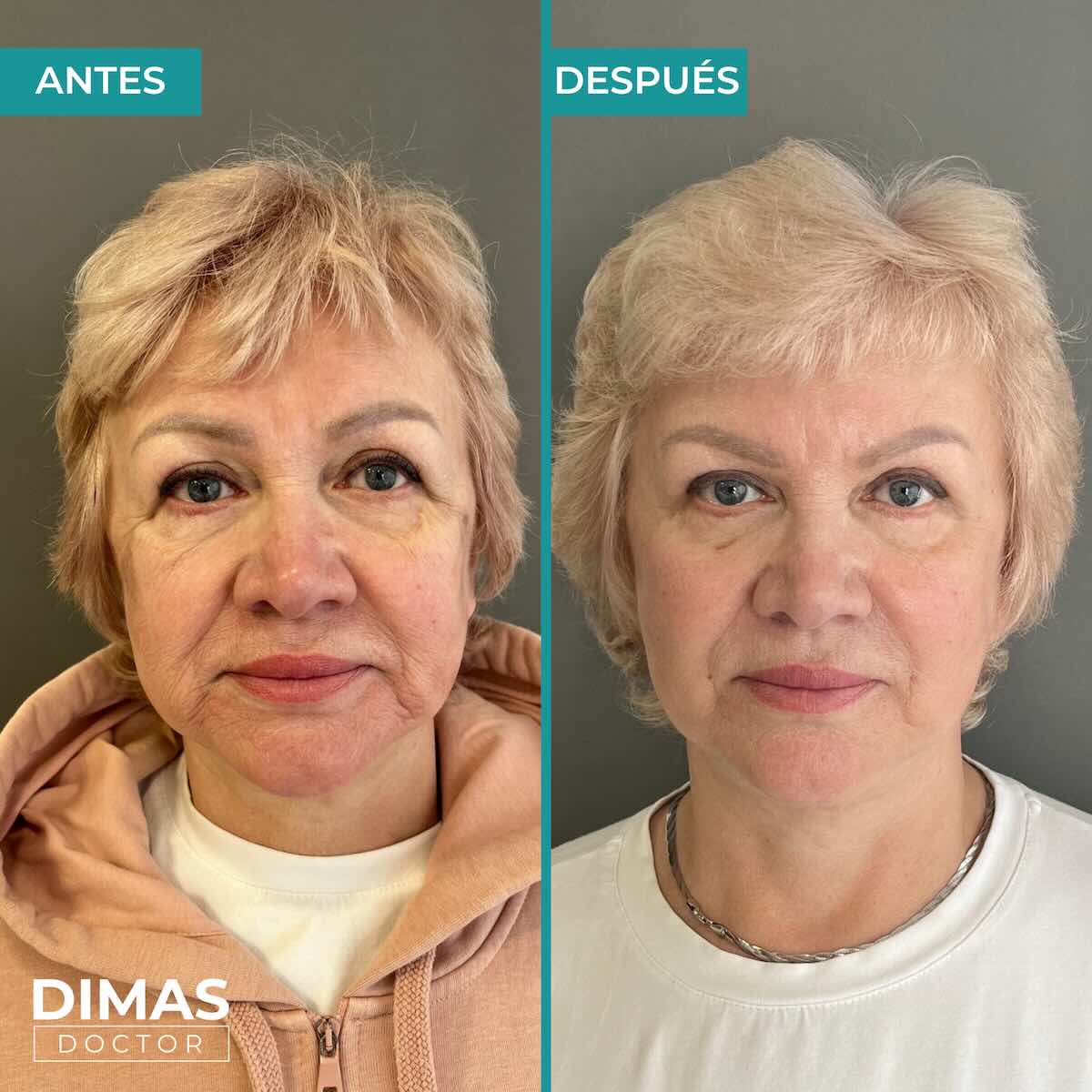 Estimulación de colágeno sculptra facial mujer