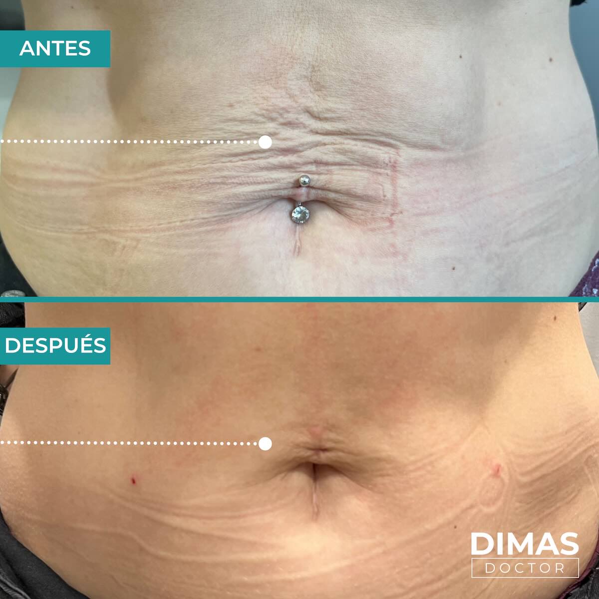 Estimulación de colágeno sculptra corporal barriga