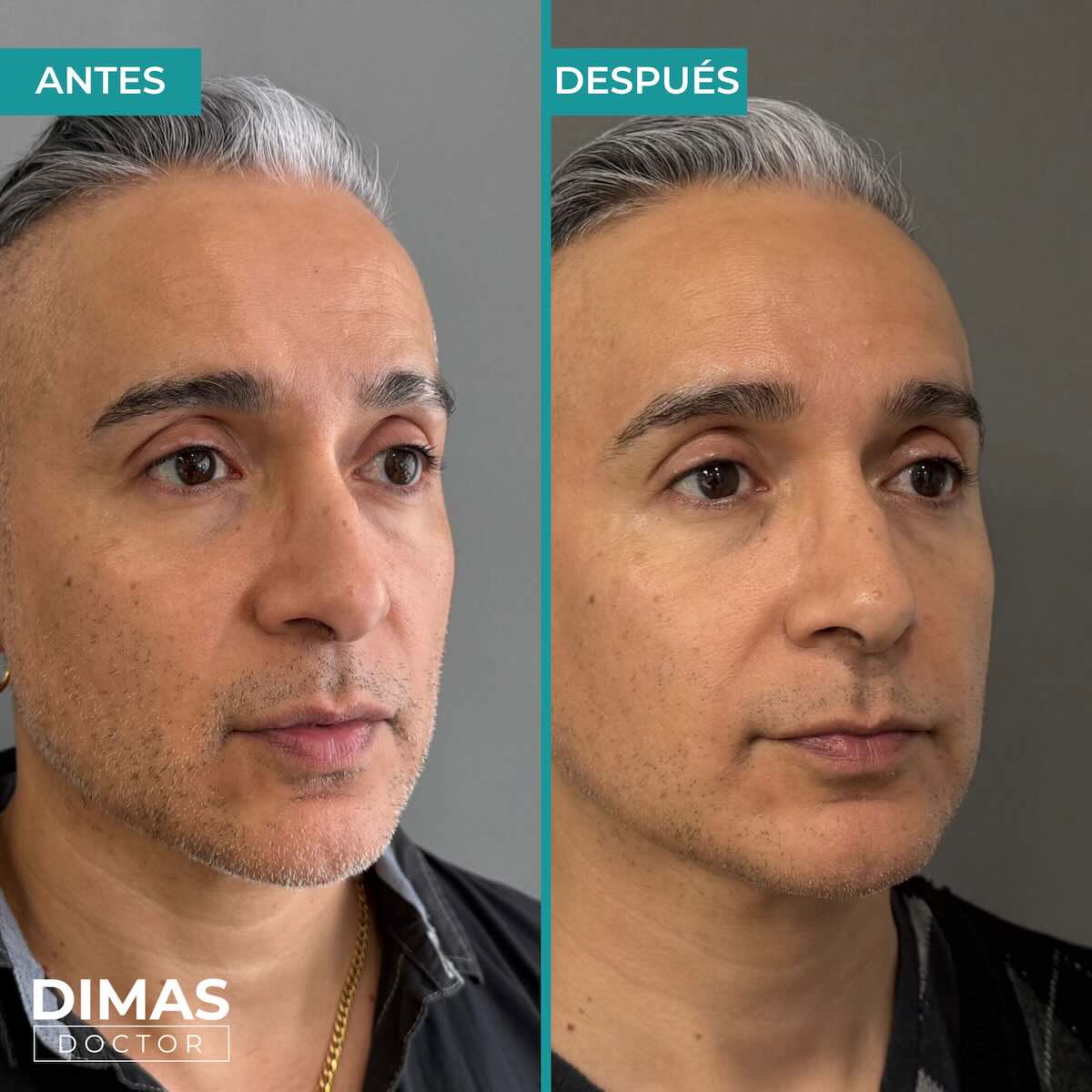 Armonización facial en rostro de hombre en Barcelona