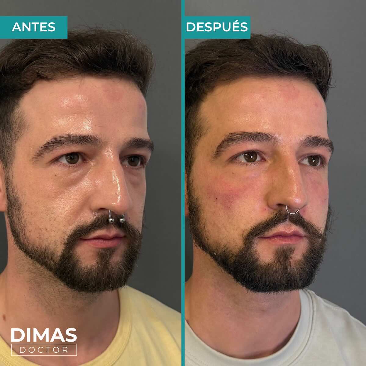 Armonización facial en rostro de hombre en Barcelona