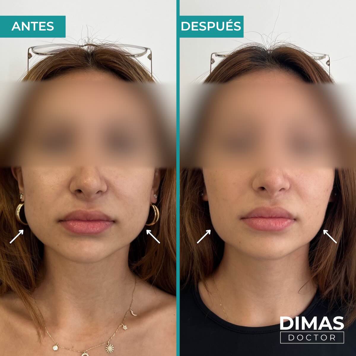 Tratamiento de bruxismo con bótox (toxina botulínica) en mujer