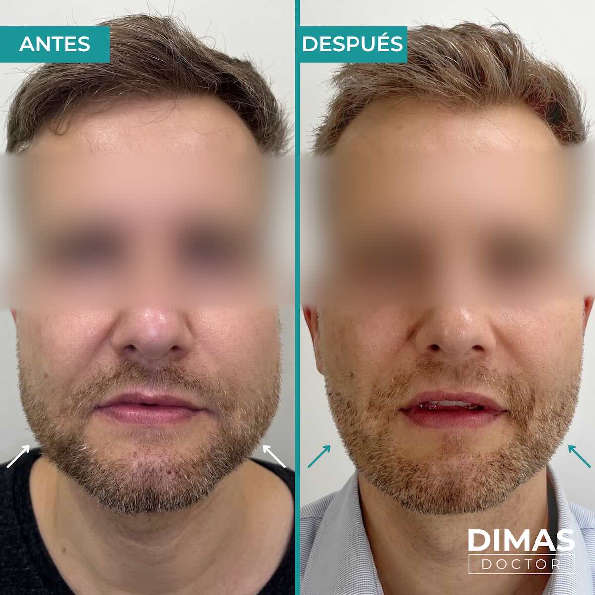 Tratamiento de bruxismo con bótox (toxina botulínica) en hombre