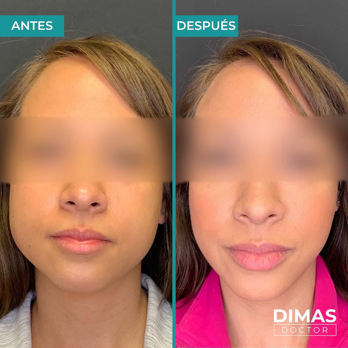 Tratamiento de bruxismo con bótox (toxina botulínica) en mujer