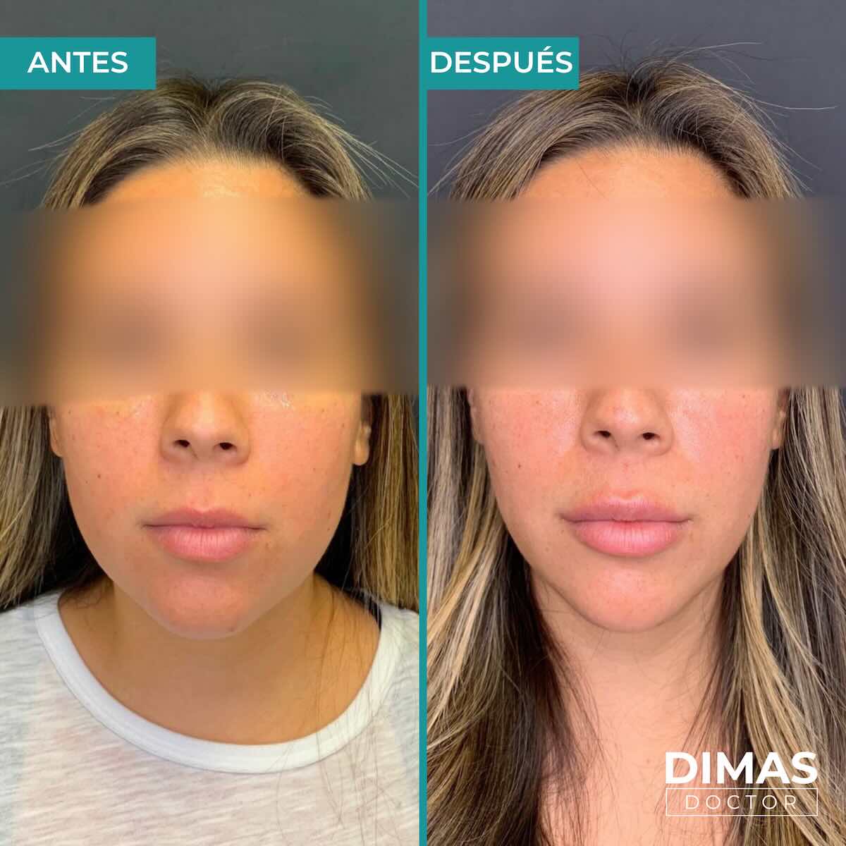 Tratamiento de bruxismo con bótox (toxina botulínica) en mujer