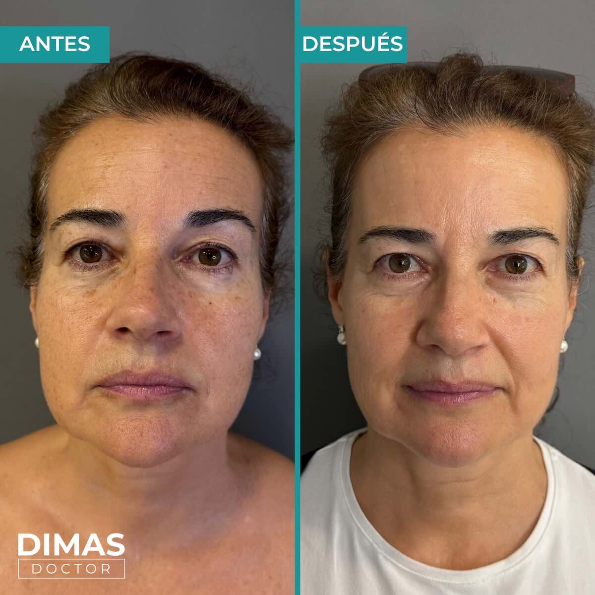 Eliminación de manchas en la cara en mujer con IPL en Barcelona