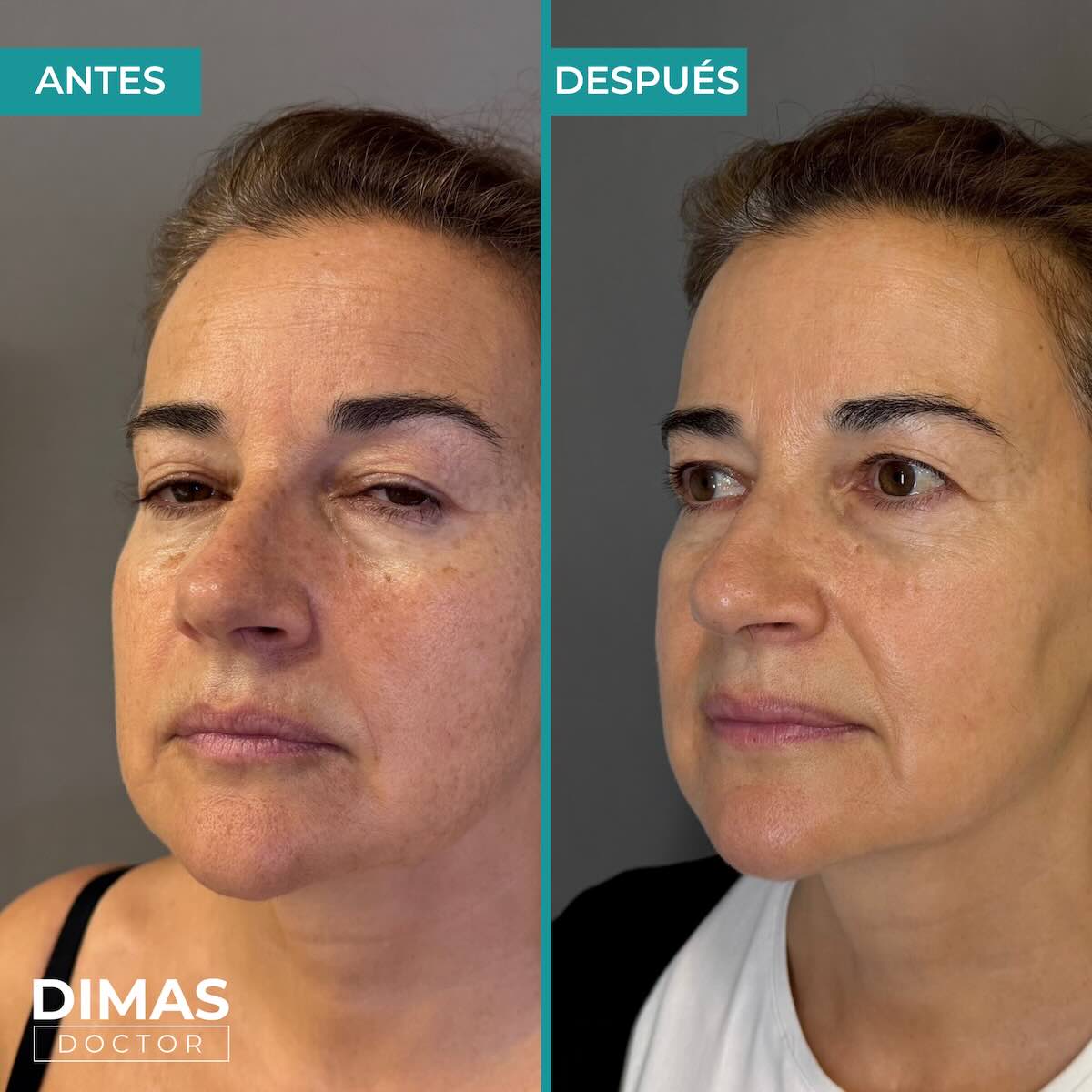 Eliminación de manchas en la cara en mujer con IPL en Barcelona