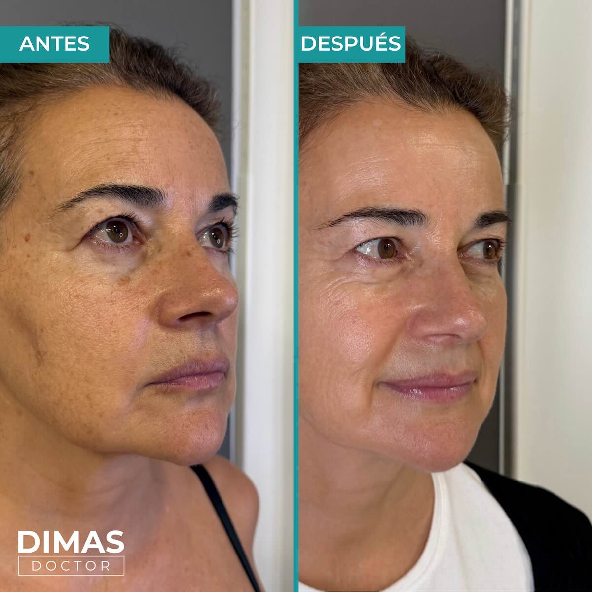 Eliminación de manchas en la cara en mujer con IPL en Barcelona