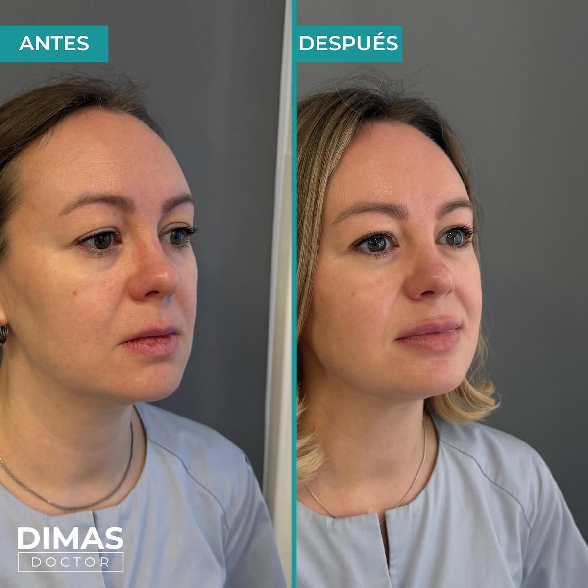 Lifting sobre la cara de una mujer sin cirugía con Ultraformer MPT HIFU