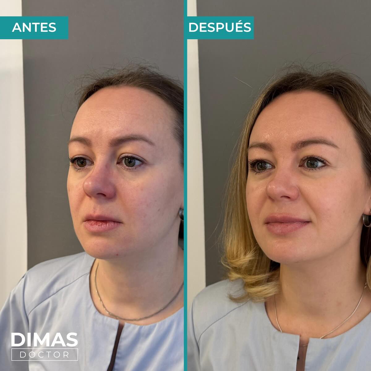 Lifting sobre la cara de una mujer sin cirugía con Ultraformer MPT HIFU