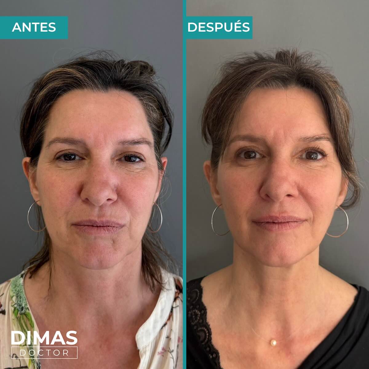 Lifting sobre la cara de una mujer sin cirugía con Ultraformer MPT HIFU