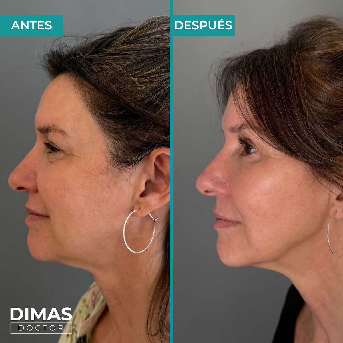 Lifting sobre la cara de una mujer sin cirugía con Ultraformer MPT HIFU