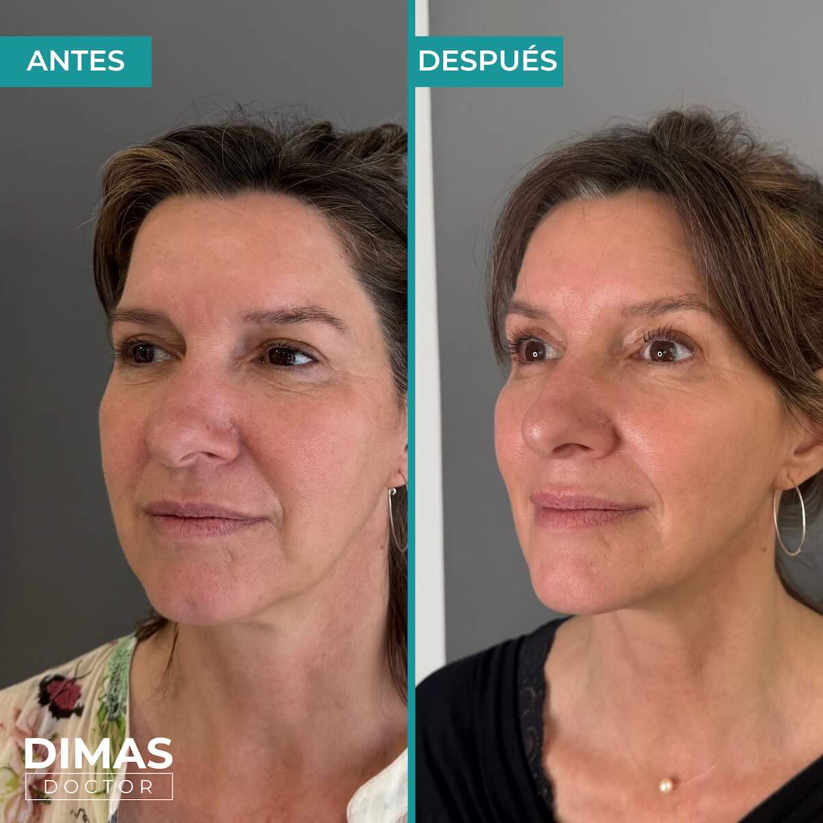 Lifting sobre la cara de una mujer sin cirugía con Ultraformer MPT HIFU