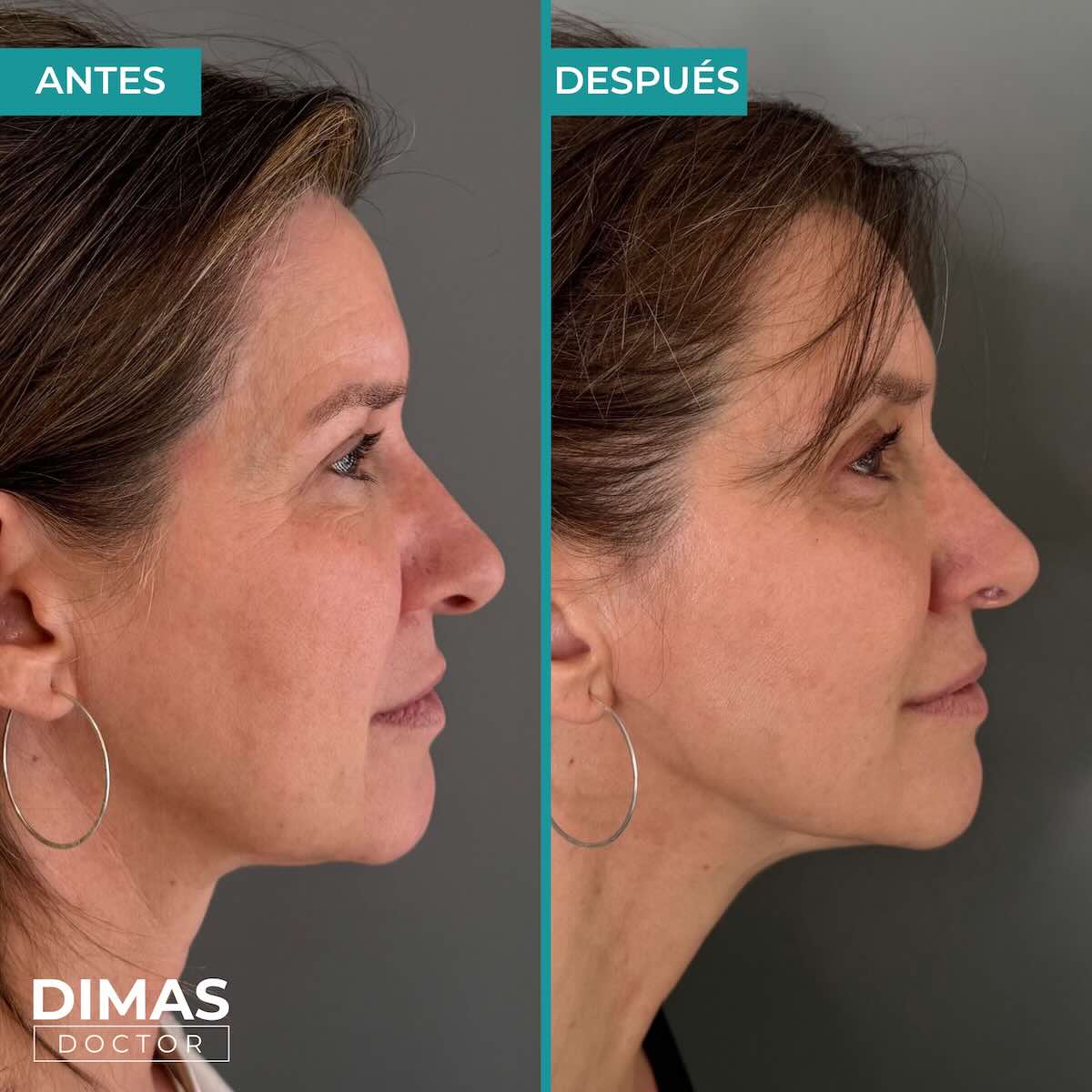 Lifting sobre la cara de una mujer sin cirugía con Ultraformer MPT HIFU