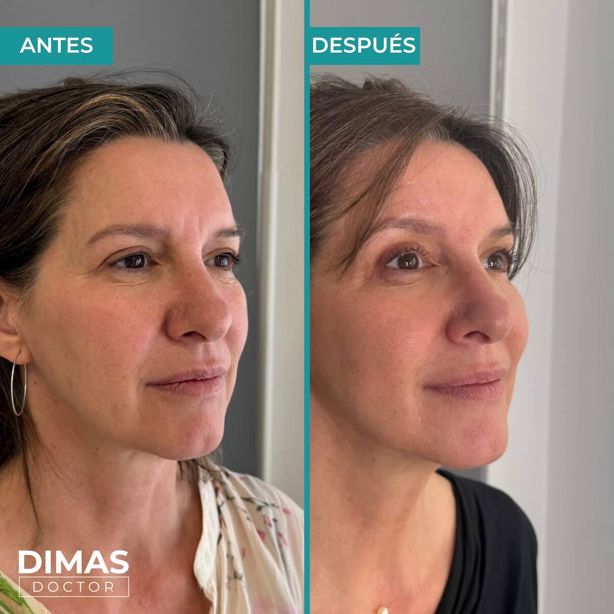 Lifting sobre la cara de una mujer sin cirugía con Ultraformer MPT HIFU