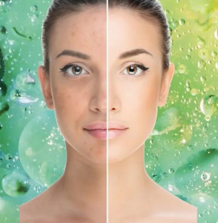 Peeling químico con TCA mujer barcelona