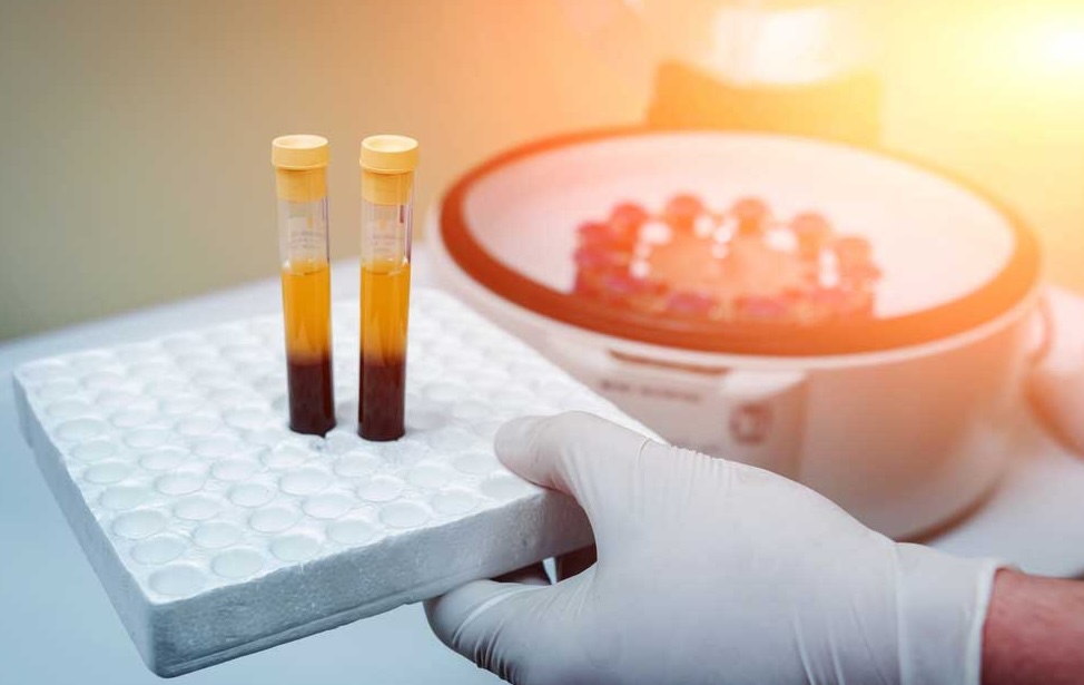 PRP facial tubitos con sangre y plasma en laboratorio de Barcelona