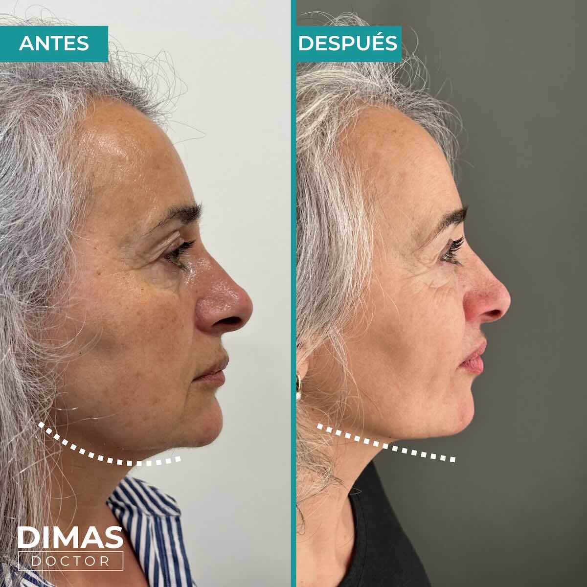 Mujer tras tratamiento con Radiesse inductor de colágeno en barcelona