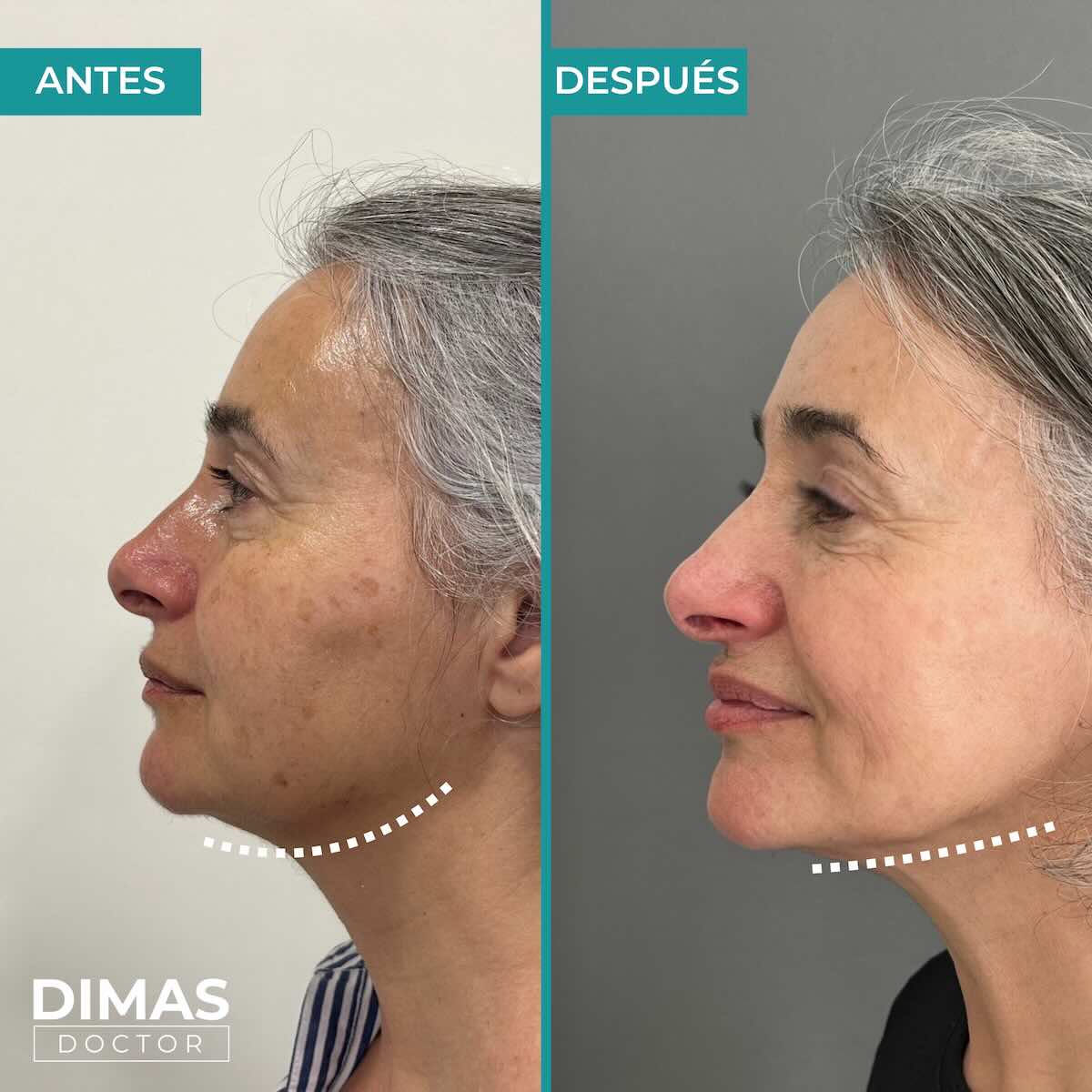 Mujer tras tratamiento con Radiesse bioestimulador de colágeno en barcelona