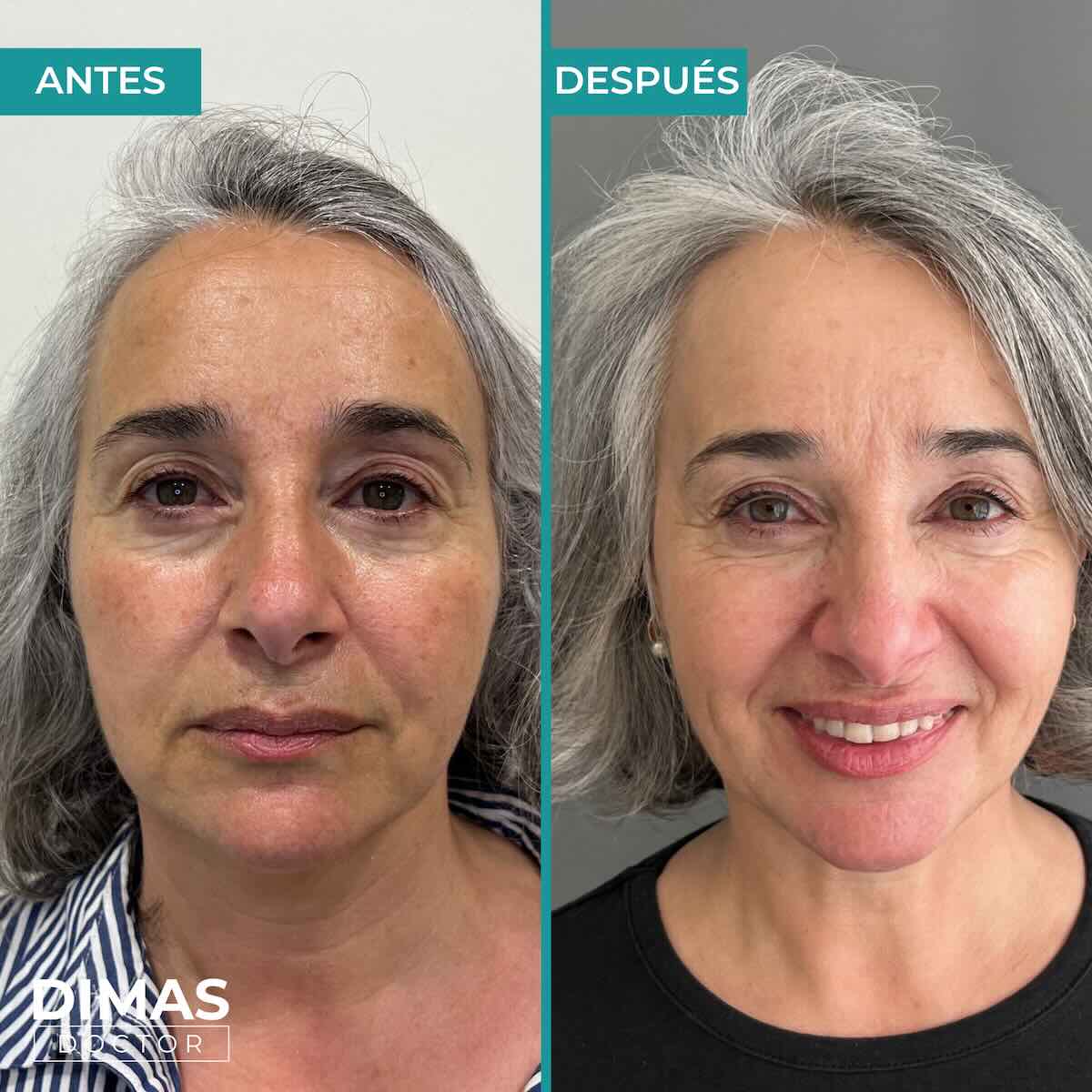 Mujer tras tratamiento con Radiesse inductor de colágeno en barcelona