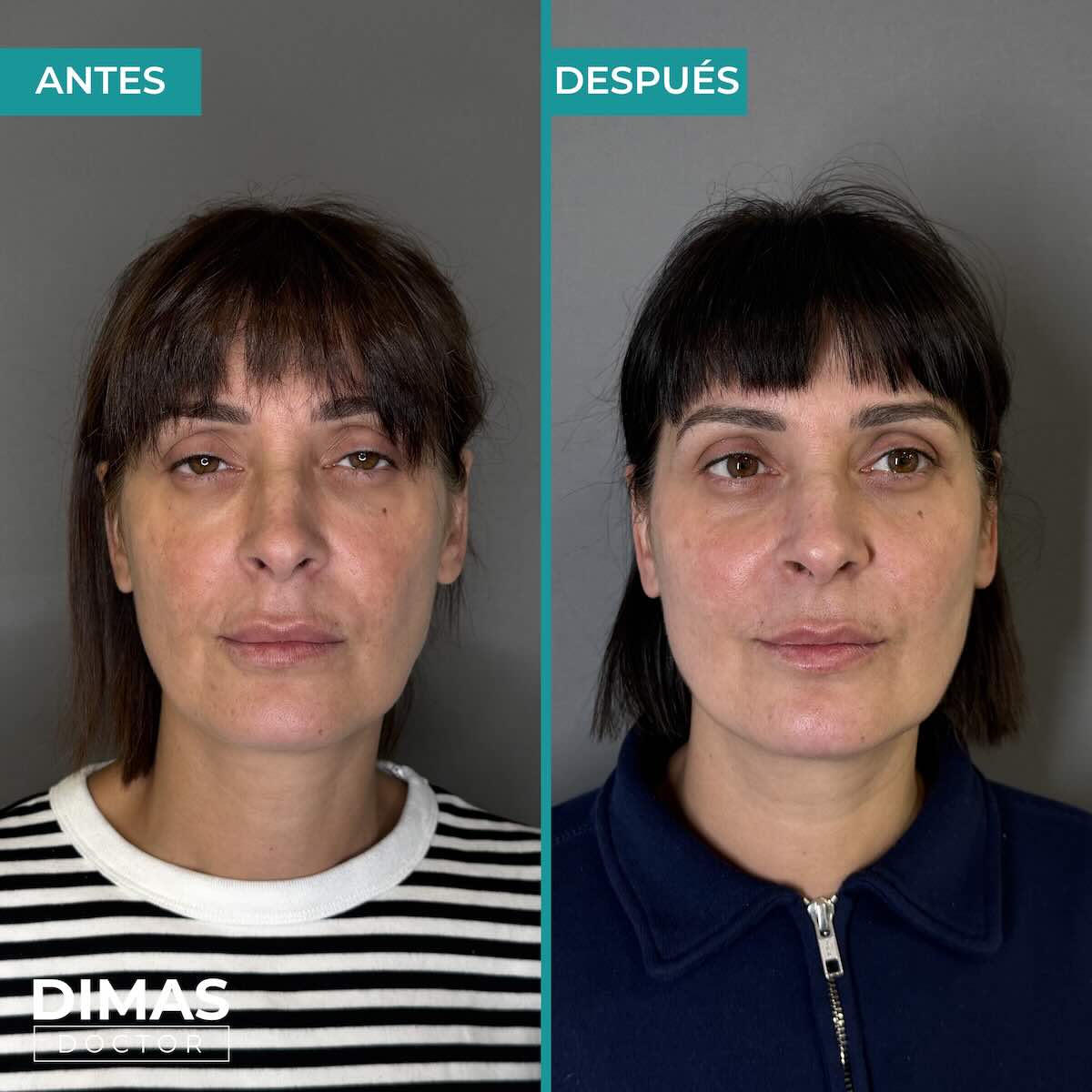 Armonización facial con ácido hialurónico en mujer Barcelona