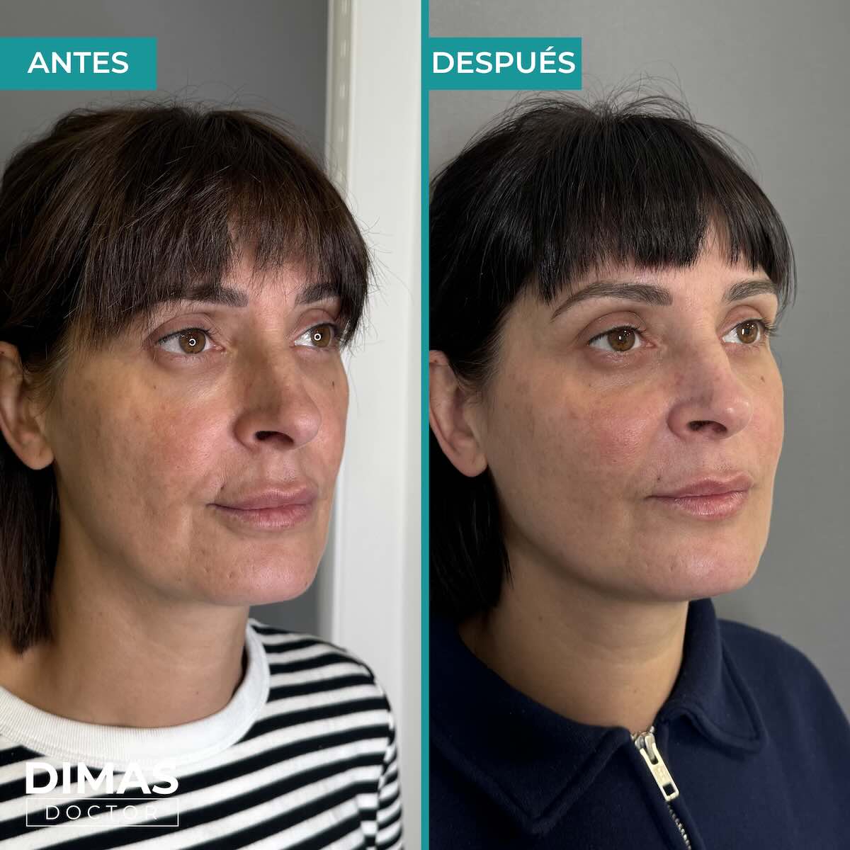 Armonización facial con ácido hialurónico en mujer Barcelona