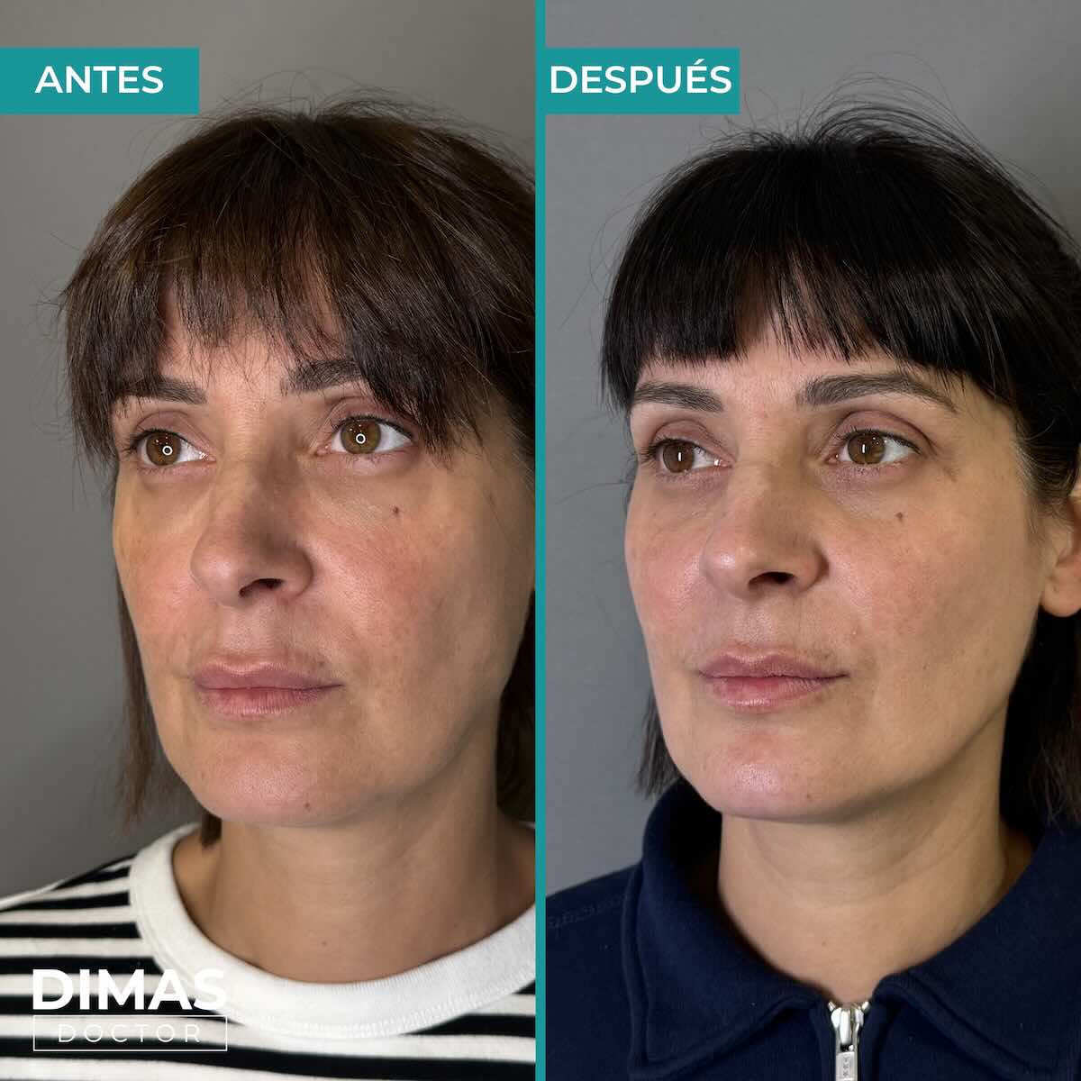 Armonización facial con ácido hialurónico en mujer Barcelona