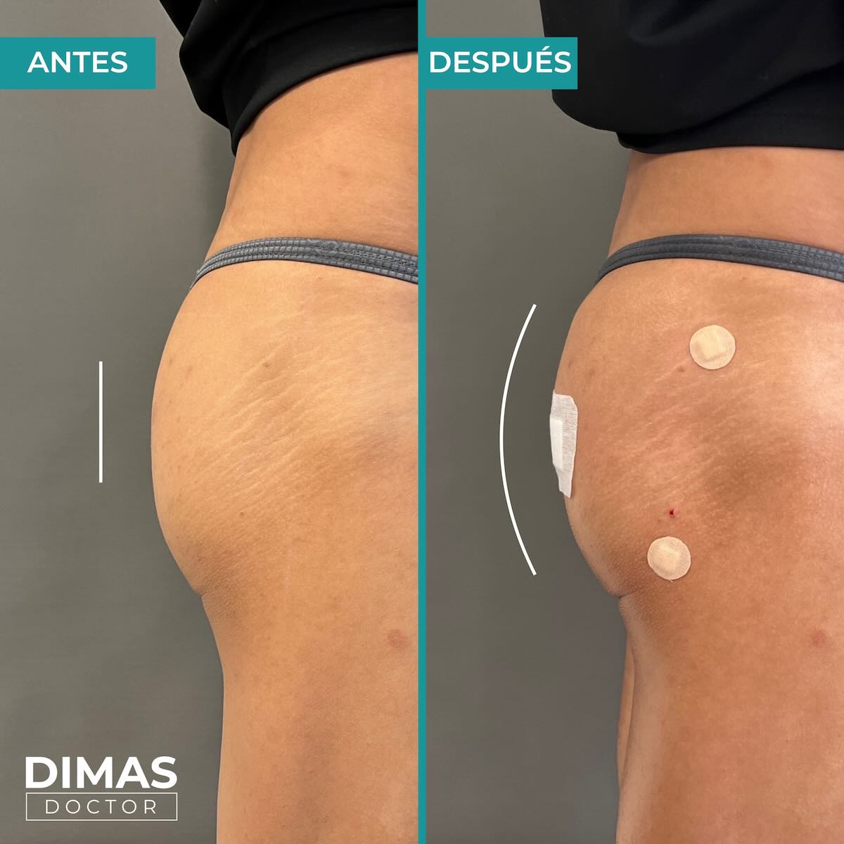 Antes y después del tratamiento de aumento de glúteos con ácido hialurónico en Barcelona