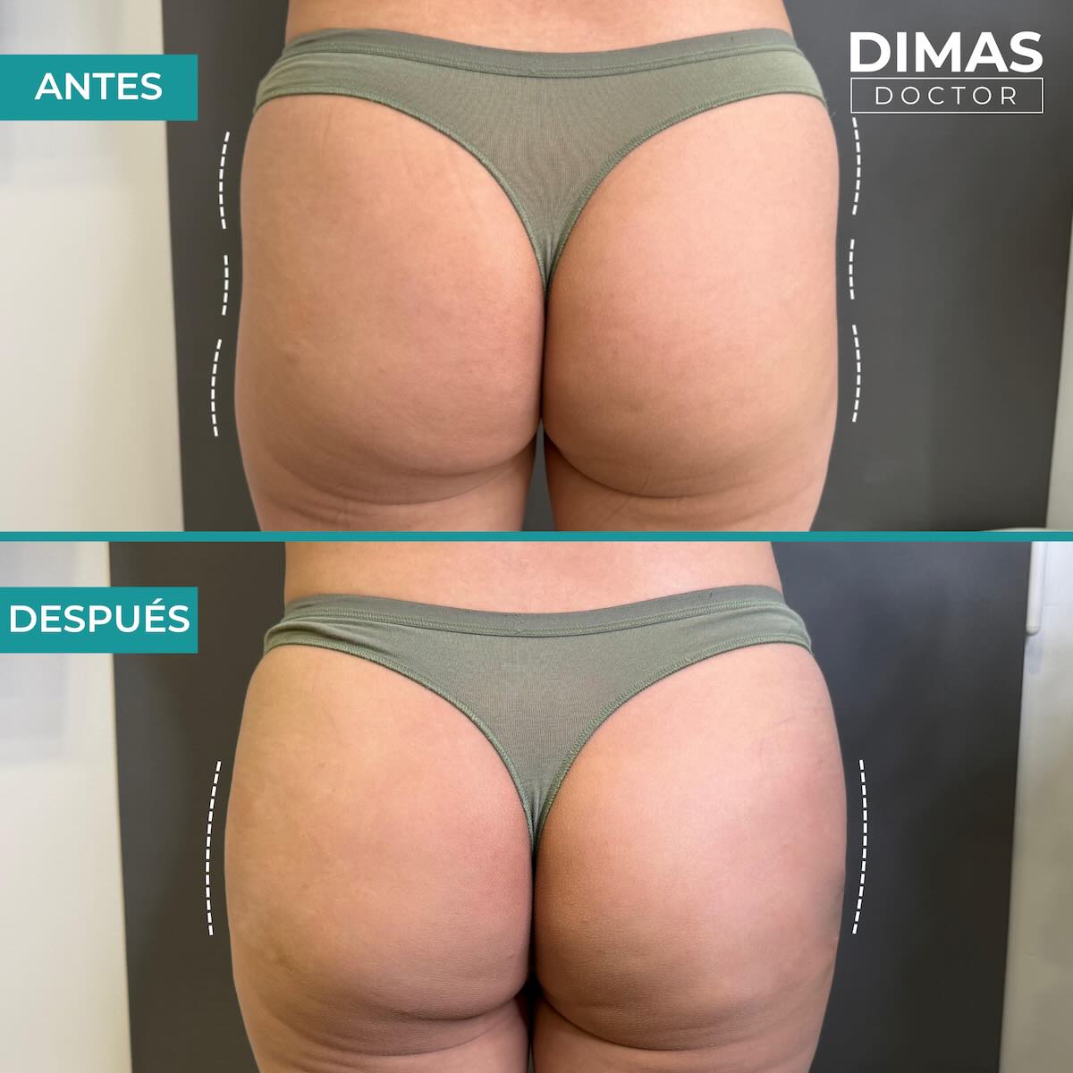 Vista de glúteos de espaldas con ropa interior de antes y después del tratamiento de aumento con ácido hialurónico