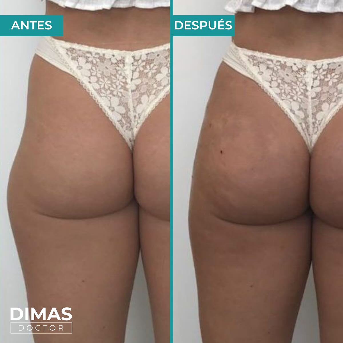 Vista de glúteos de espaldas con ropa interior de antes y después del tratamiento de aumento con ácido hialurónico